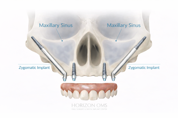 Advanced implant solutions for severe upper jaw bone loss including zygomatic and pterygoid implants in Lombard Illinois