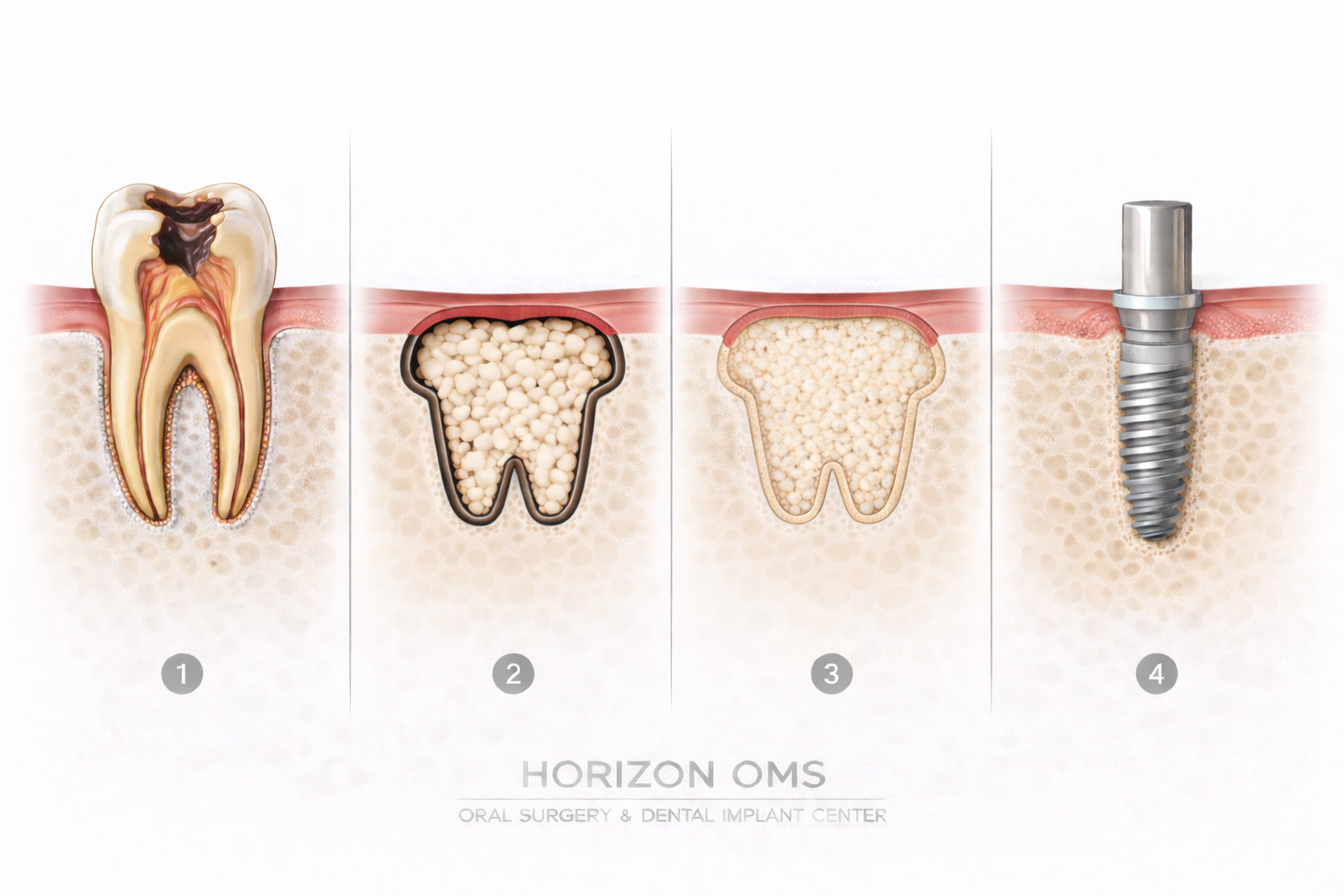 Bone graft healing and consolidation before implant placement