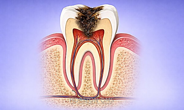 Tooth extraction surgery Western Chicago suburbs oral surgeon