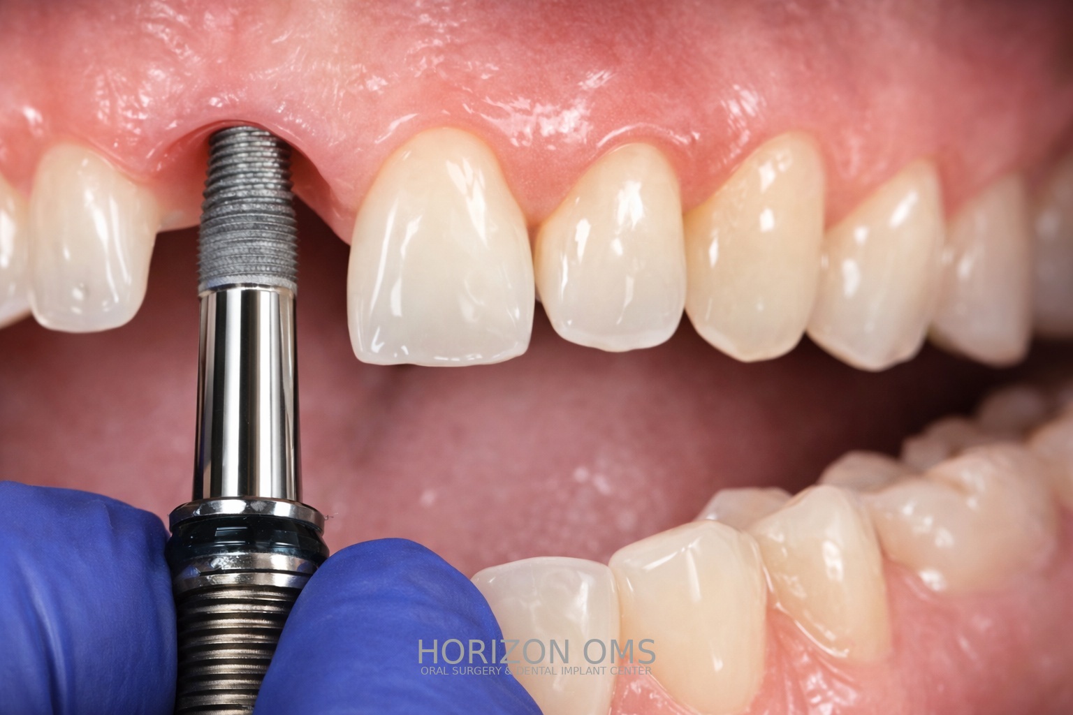 Dental implant placement procedure by board-certified oral surgeon in Lombard IL