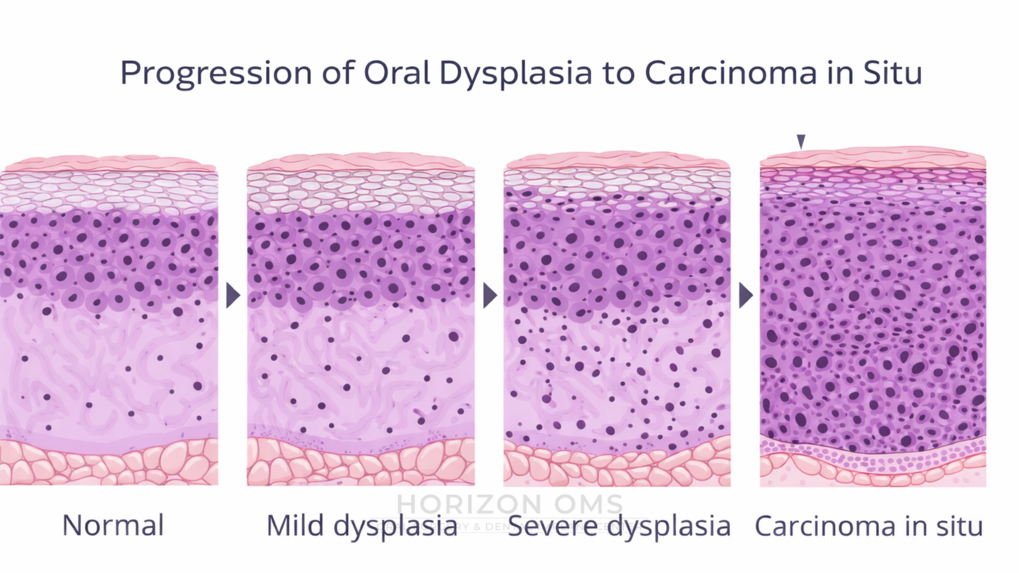 Progression from normal oral mucosa to mild dysplasia, severe dysplasia, and carcinoma in situ