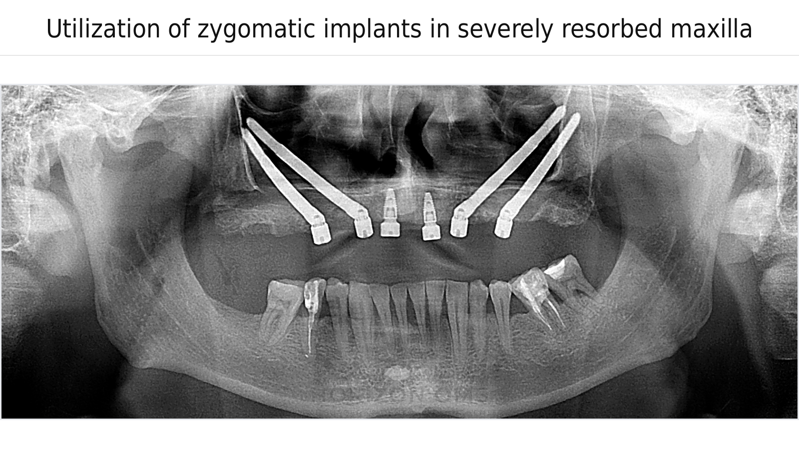 Panoramic dental X-ray showing bilateral zygomatic implant placement supporting a fixed full-arch prosthesis in a severely resorbed maxilla
