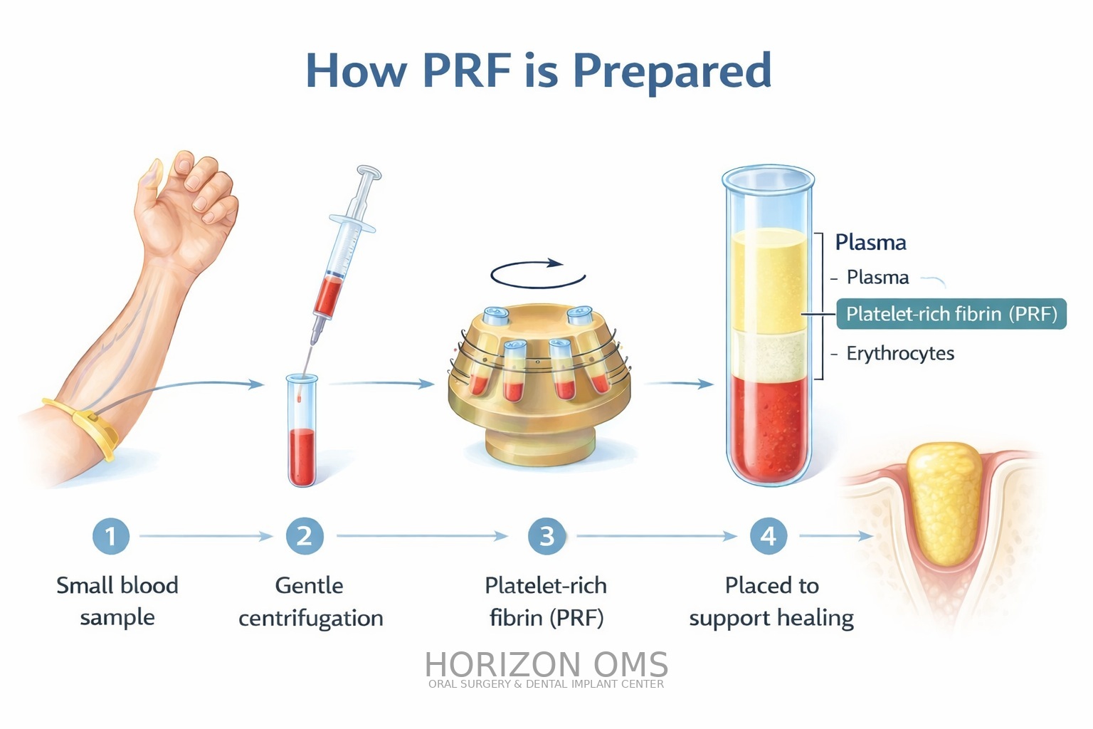 PRF platelet-rich fibrin therapy for enhanced healing after oral surgery