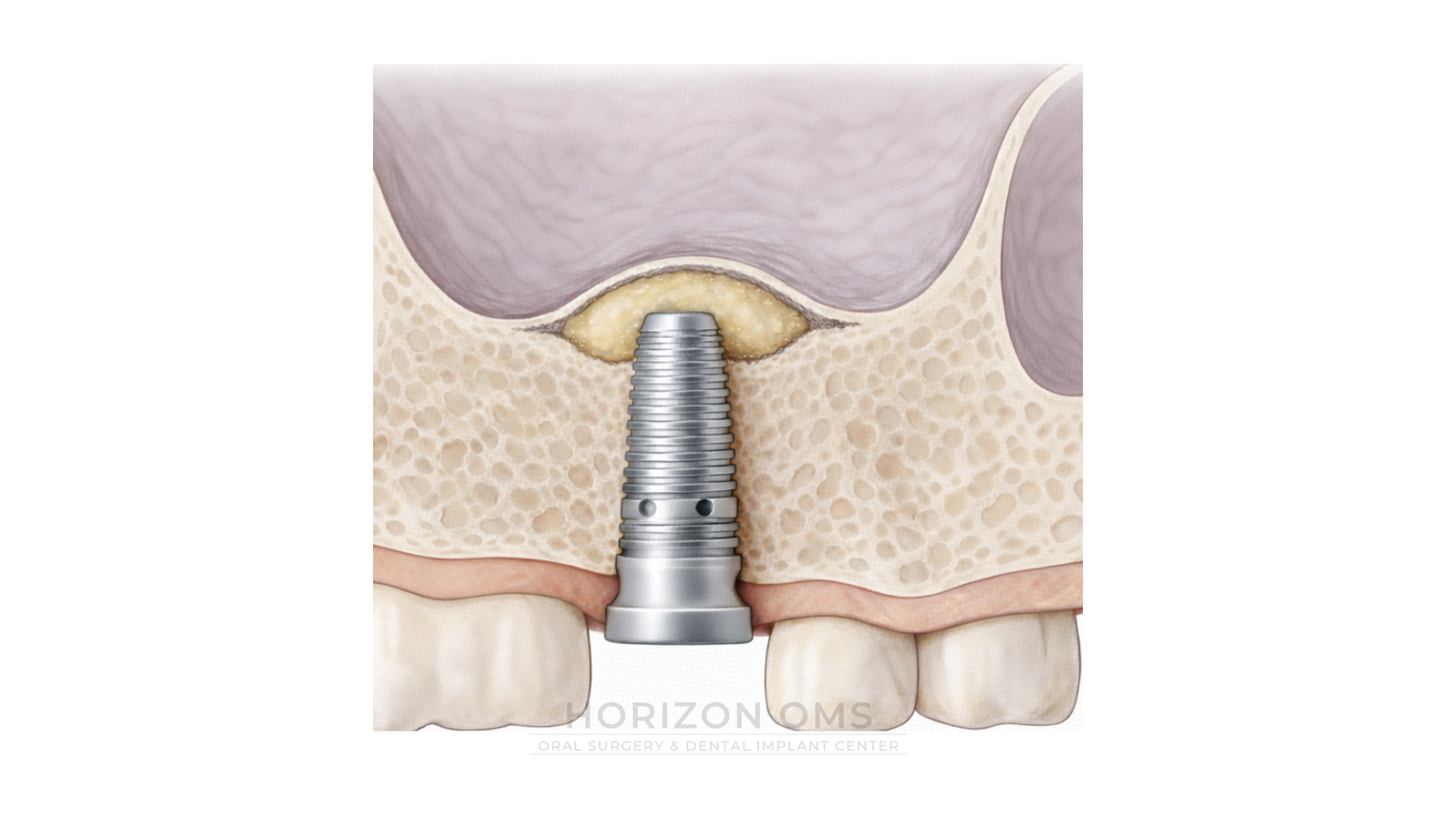 Illustration of an upper molar implant placed with an indirect crestal (mini) sinus lift