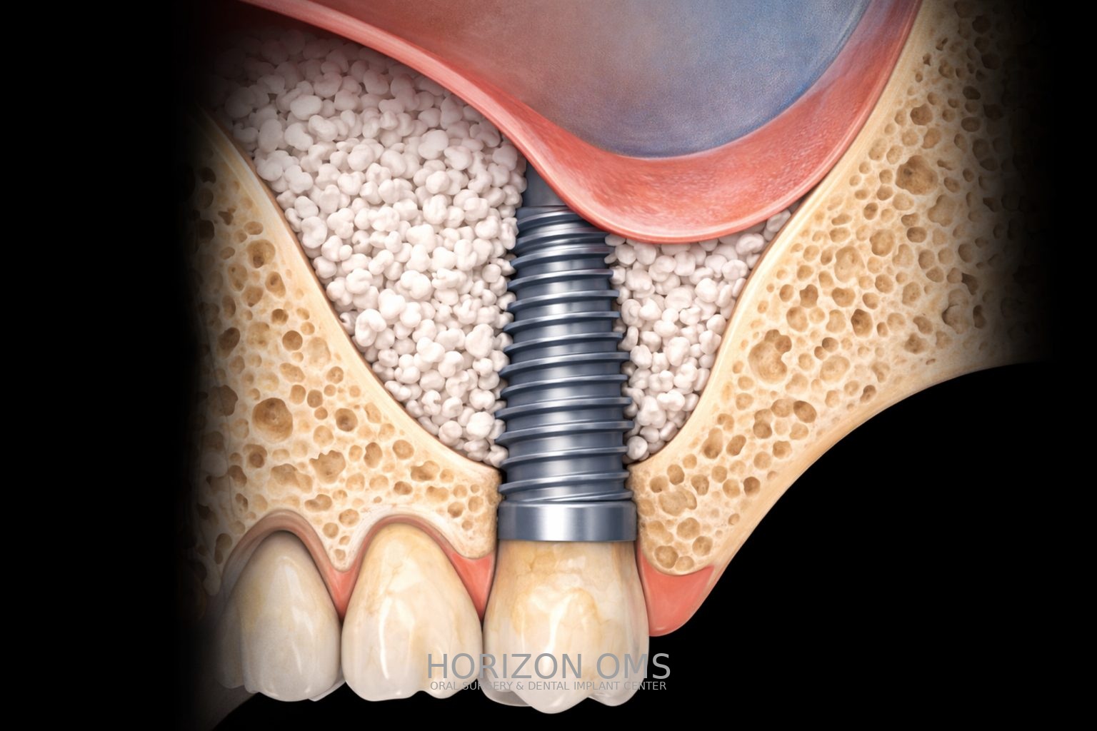 Sinus lift augmentation procedure for upper jaw dental implants Illinois