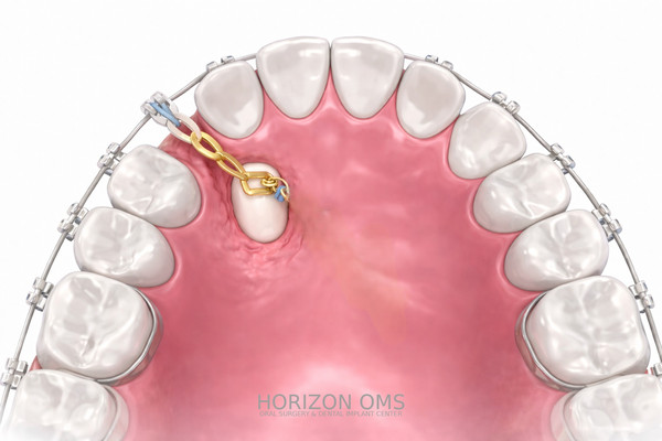 Surgical orthodontic procedures coordinated with orthodontist in Western suburbs