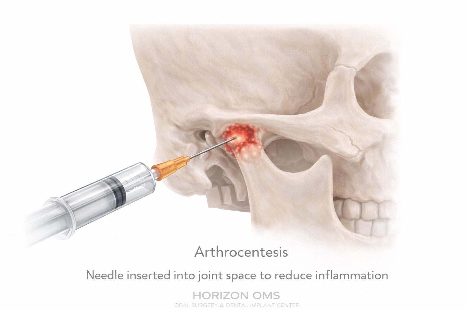 TMJ arthrocentesis procedure illustration showing joint lavage technique