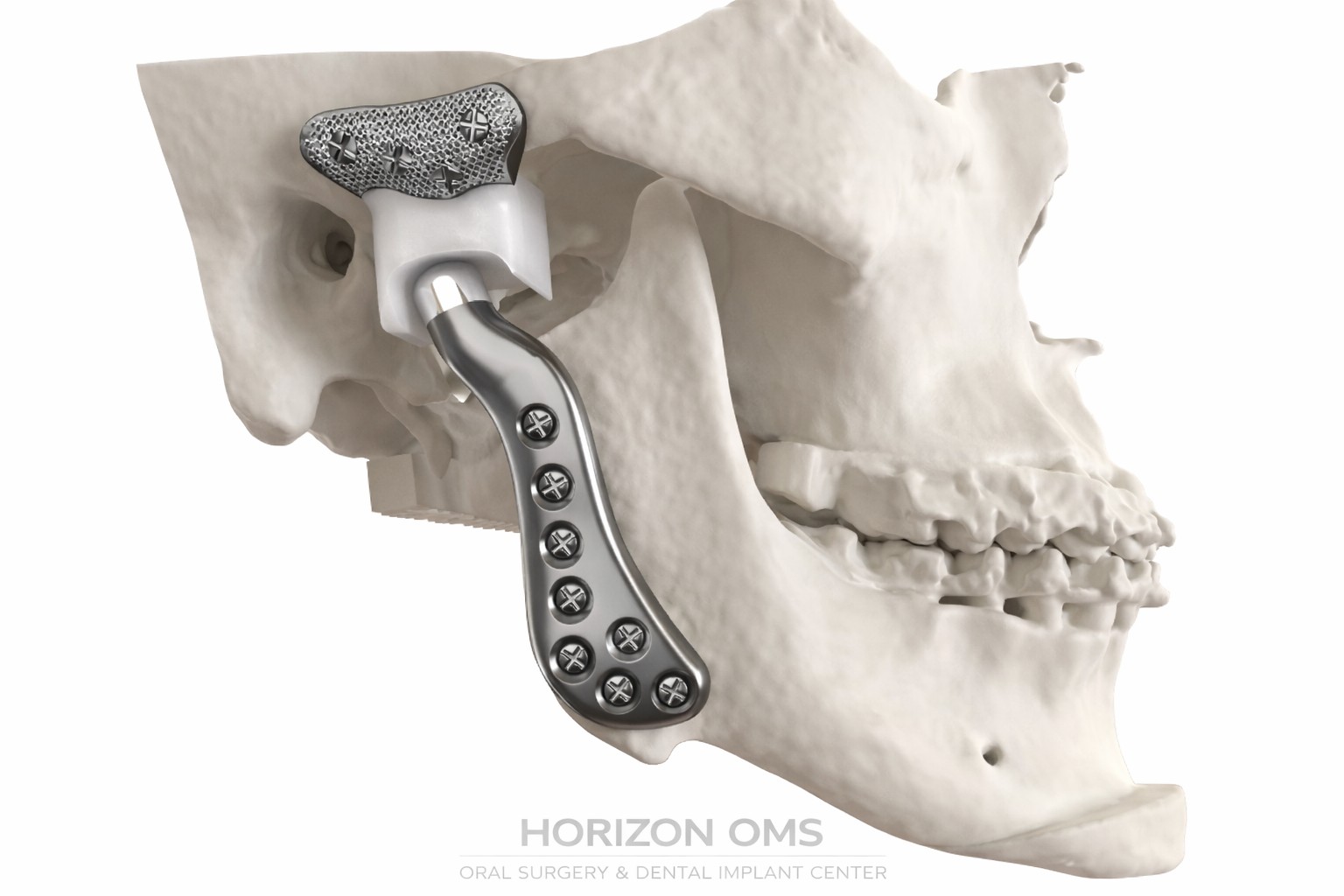 TMJ disorder treatment and jaw pain relief Lombard IL specialist