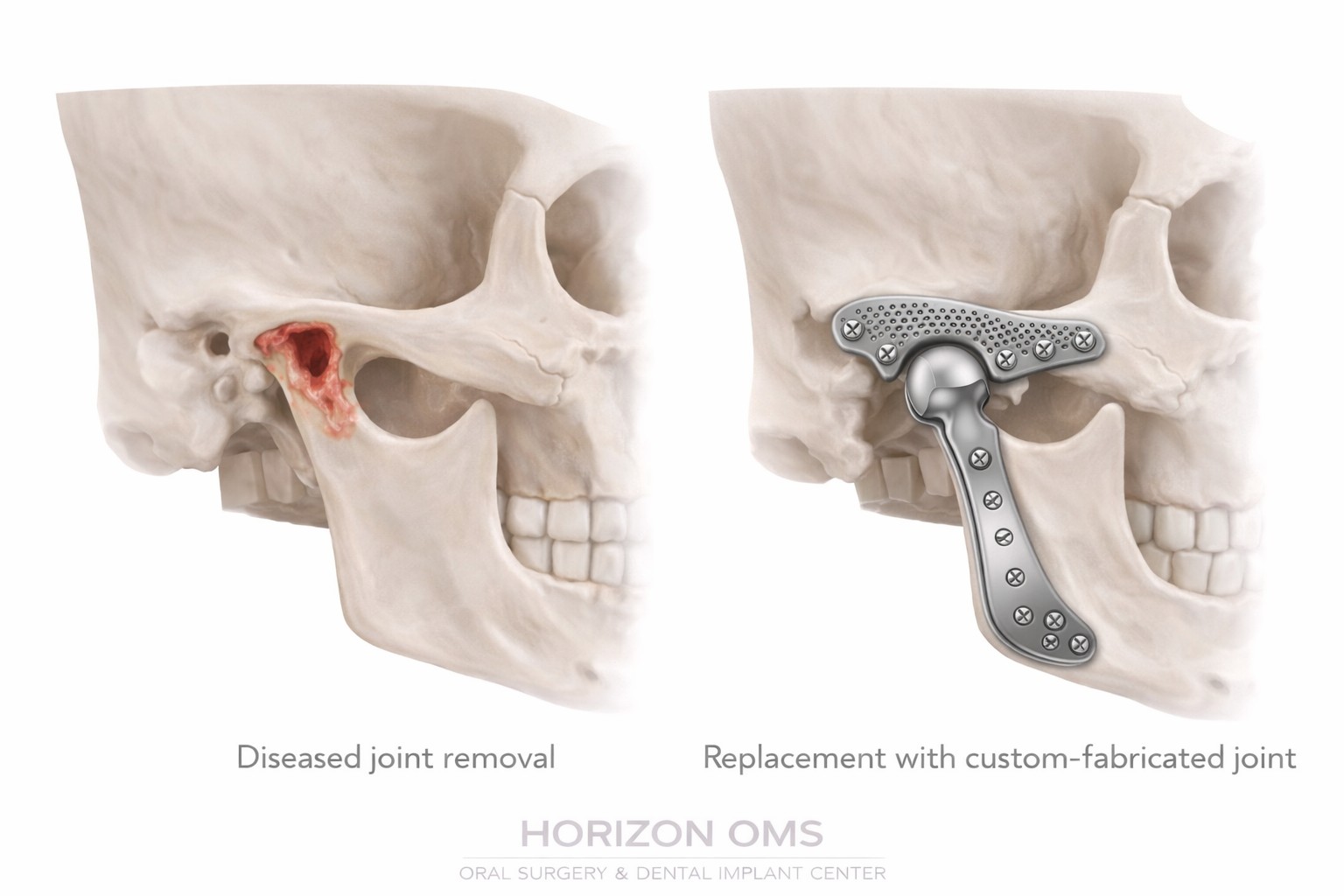 TMJ joint replacement before and after comparison diagram