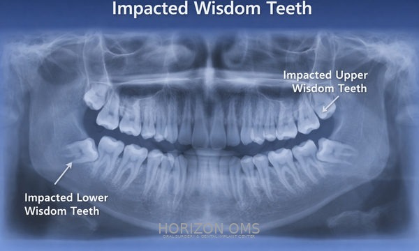 Wisdom teeth removal surgery by board-certified oral surgeon in Lombard IL